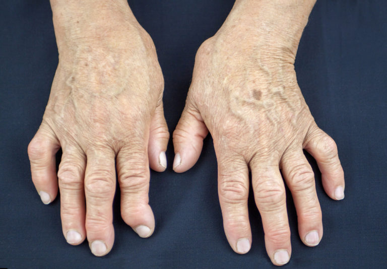 Complicaciones de la artritis